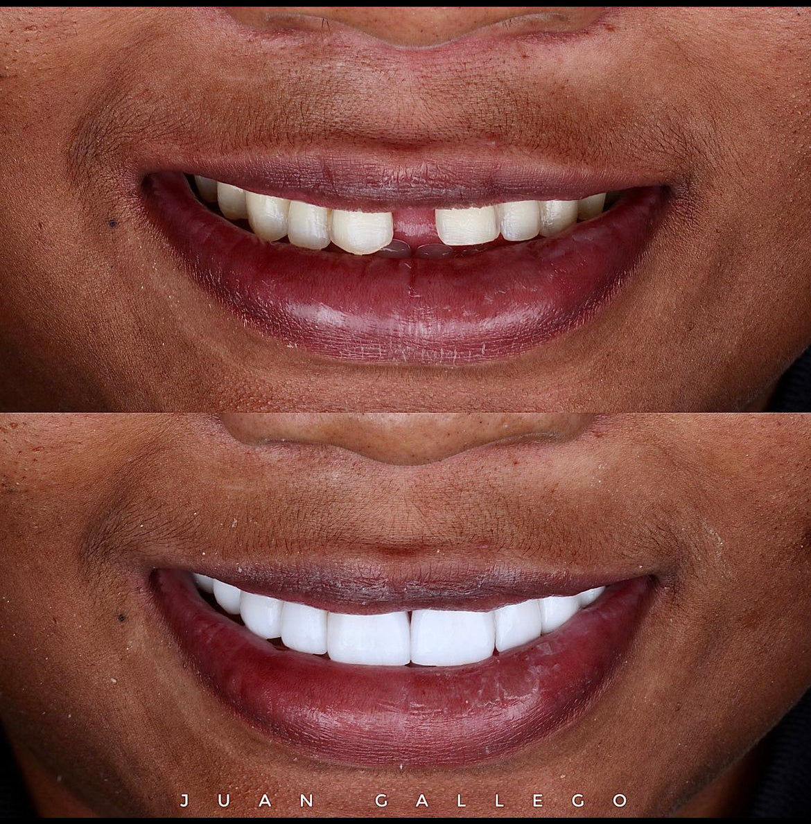 comparison of incomplete and complete smile